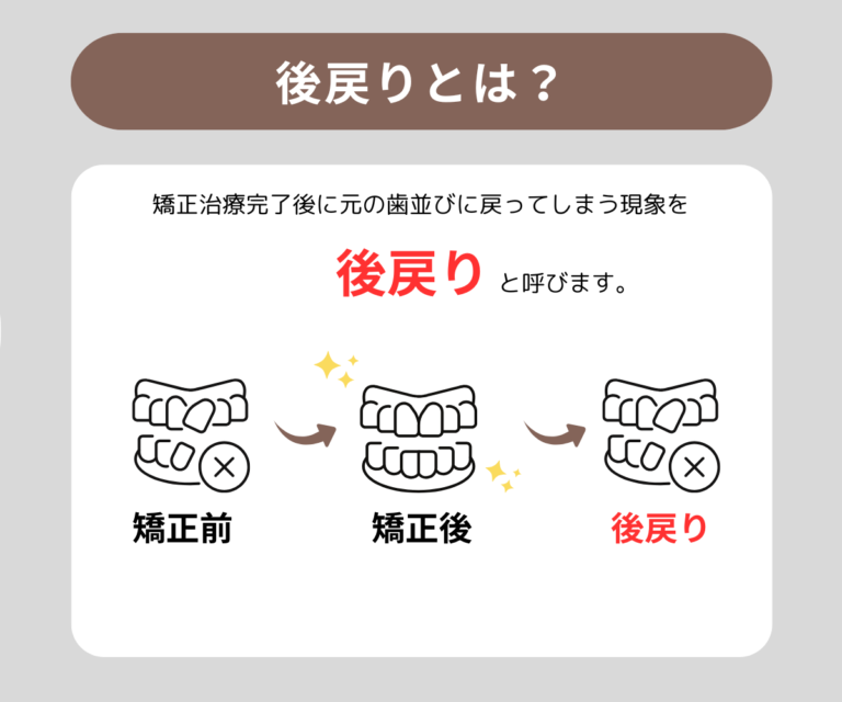 矯正治療後に歯並びが戻るのはなぜ?後戻りの原因や予防法をプルチーノ歯科・矯正歯科が解説 | 名古屋でインビザライン矯正・小児矯正|プルチーノ ...