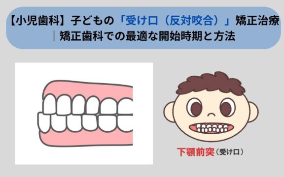よ*ん様 反対咬合　マウスピース　S 反対咬合を改善するマウスピース矯正法 | TikTok